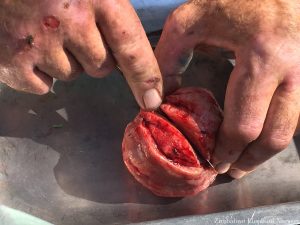 A tumour of a size of an orange was removed